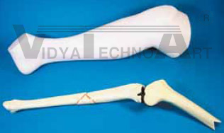 Tibia, fractured, foam coat